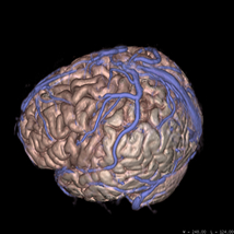 脳立体MRI