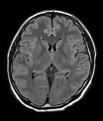 頭部MRI