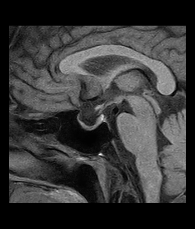 下垂体MRI