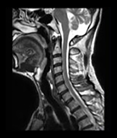 頸椎MRI